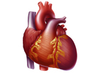 Heart with congestive heart failure showing an enlarged left ventricle. Heart with congestive heart failure showing an enlarged left ventricle.