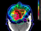 An image with radiation doses from proton therapy superimposed.