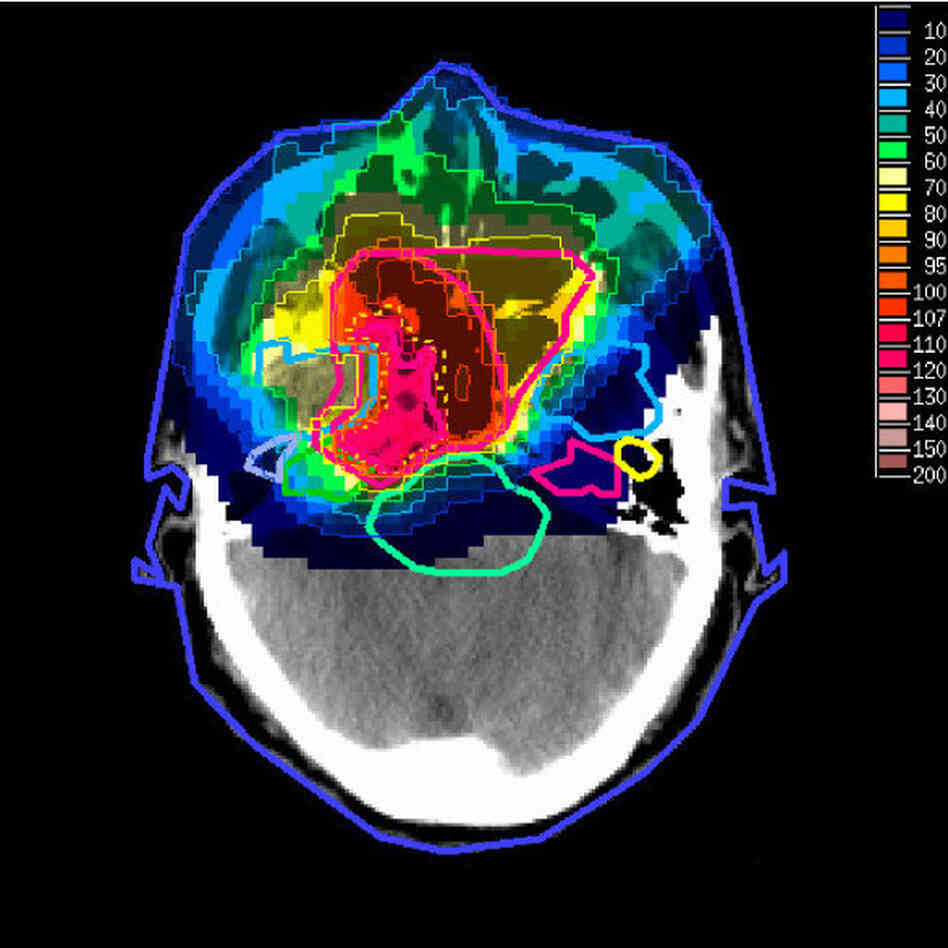 An image with radiation doses from proton therapy superimposed. An image with radiation doses from proton therapy superimposed.