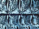 Spinal MRIs similar to these found infections that many patients hadn't realized they had. Spinal MRIs similar to these found infections that many patients hadn't realized they had.