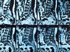 Spinal MRIs similar to these found infections that many patients hadn't realized they had. Spinal MRIs similar to these found infections that many patients hadn't realized they had.