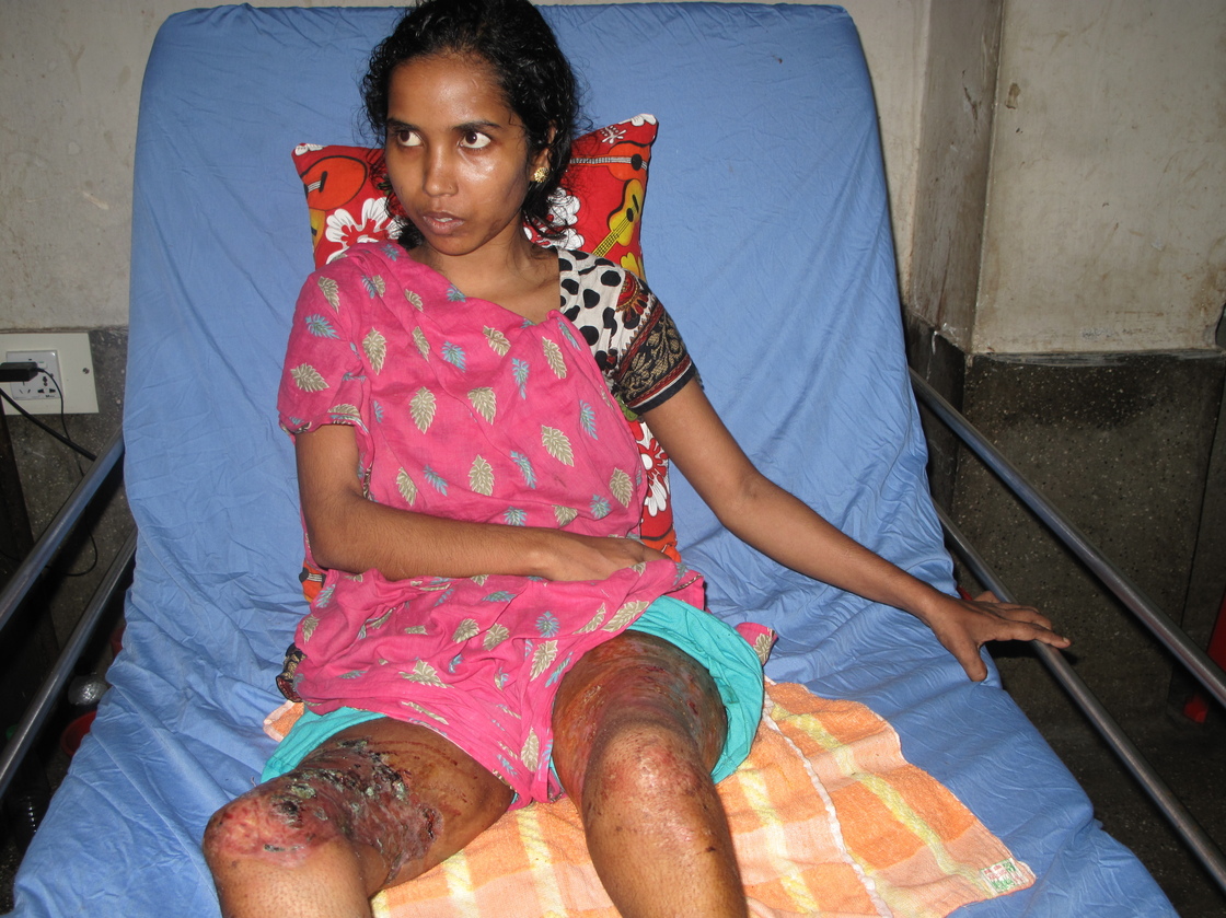 Rojina Akter was also hurt in the collapse. The 23-year-old earned $65 a month as a sewer's assistant. 