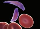 Red blood cells are normally shaped like doughnuts, but sickle cells (purple) are flattened and clump together. Red blood cells are normally shaped like doughnuts, but sickle cells (purple) are flattened and clump together.