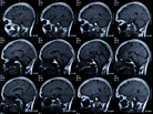The main goal in stroke treatment: saving brain. The main goal in stroke treatment: saving brain.
