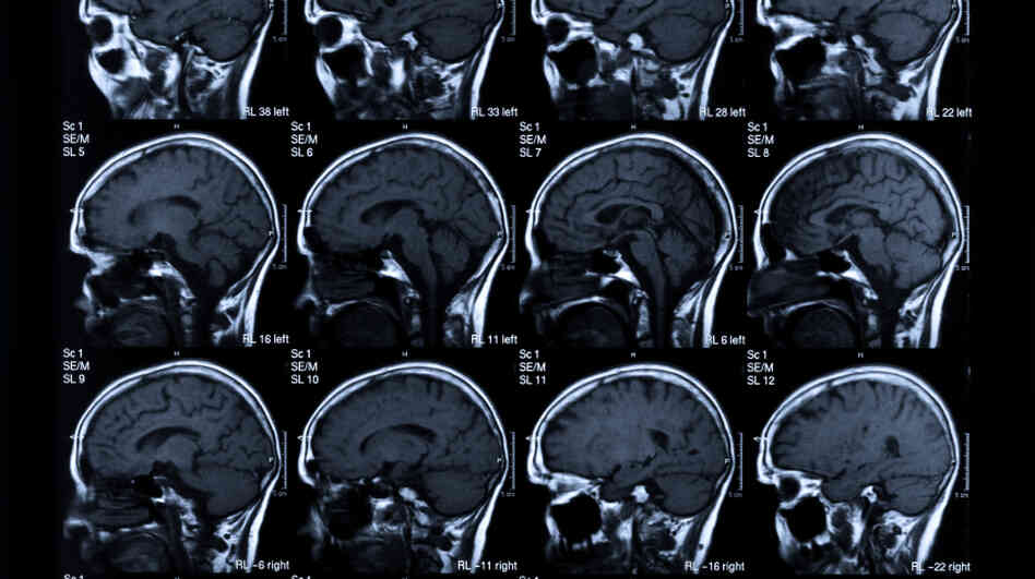 The main goal in stroke treatment: saving brain. The main goal in stroke treatment: saving brain.