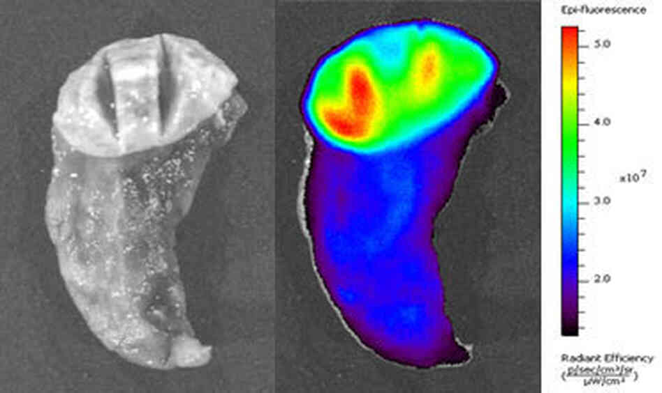 The image on the left is a piece of lung tissue that contains a tumor viewed under normal white light. The right image shows the same piece of tissue after Tumor Paint has been applied. Here it's viewed under infrared light. Areas that are more red and yellow show a concentration of the paint, which means they are more likely to be cancerous. The image on the left is a piece of lung tissue that contains a tumor viewed under normal white light. The right image shows the same piece of tissue after Tumor Paint has been applied. Here it's viewed under infrared light. Areas that are more red and yellow show a concentration of the paint, which means they are more likely to be cancerous.