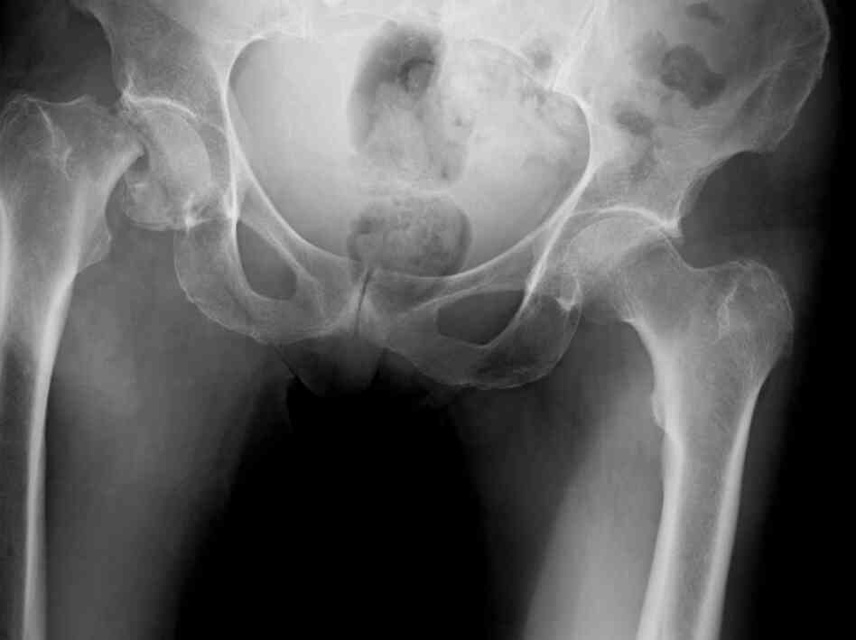 A broken hip like the one at left is a big health worry for older women. A broken hip like the one at left is a big health worry for older women.
