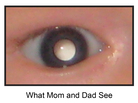 A milky eye can be a sign of early cancer of the retina. A milky eye can be a sign of early cancer of the retina.