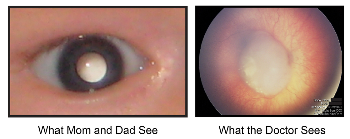 A milky eye can be a sign of early cancer of the retina.