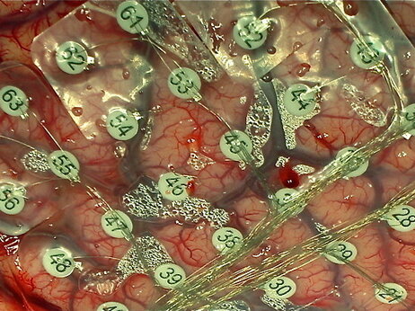 Surgeons use a grid of electrodes laid on a patient's brain. They record electrical activity and can deliver a tiny jolt. Surgeons use a grid of electrodes laid on a patient's brain. They record electrical activity and can deliver a tiny jolt.