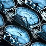 Researchers have only recently been able to use brain scans to detect Alzheimer's risk factors in living people. Researchers have only recently been able to use brain scans to detect Alzheimer's risk factors in living people.