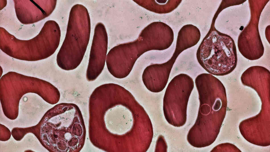 Red blood cells infected with the Plasmodium falciparum parasite. Plasmodium is the parasite that triggers malaria in people. Red blood cells infected with the Plasmodium falciparum parasite. Plasmodium is the parasite that triggers malaria in people.