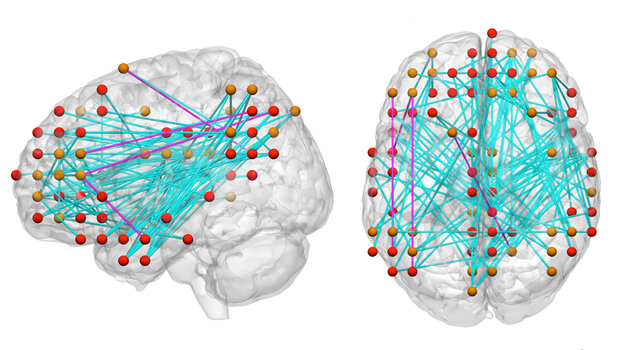 Connection maps of brain areas are helping reseachers study the causes of ADHD
