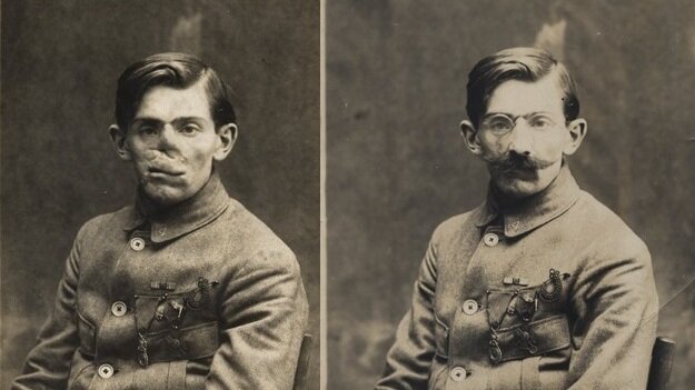 Ladd's papers include these photos of a World War I veteran with and without his mask, circa 1920.