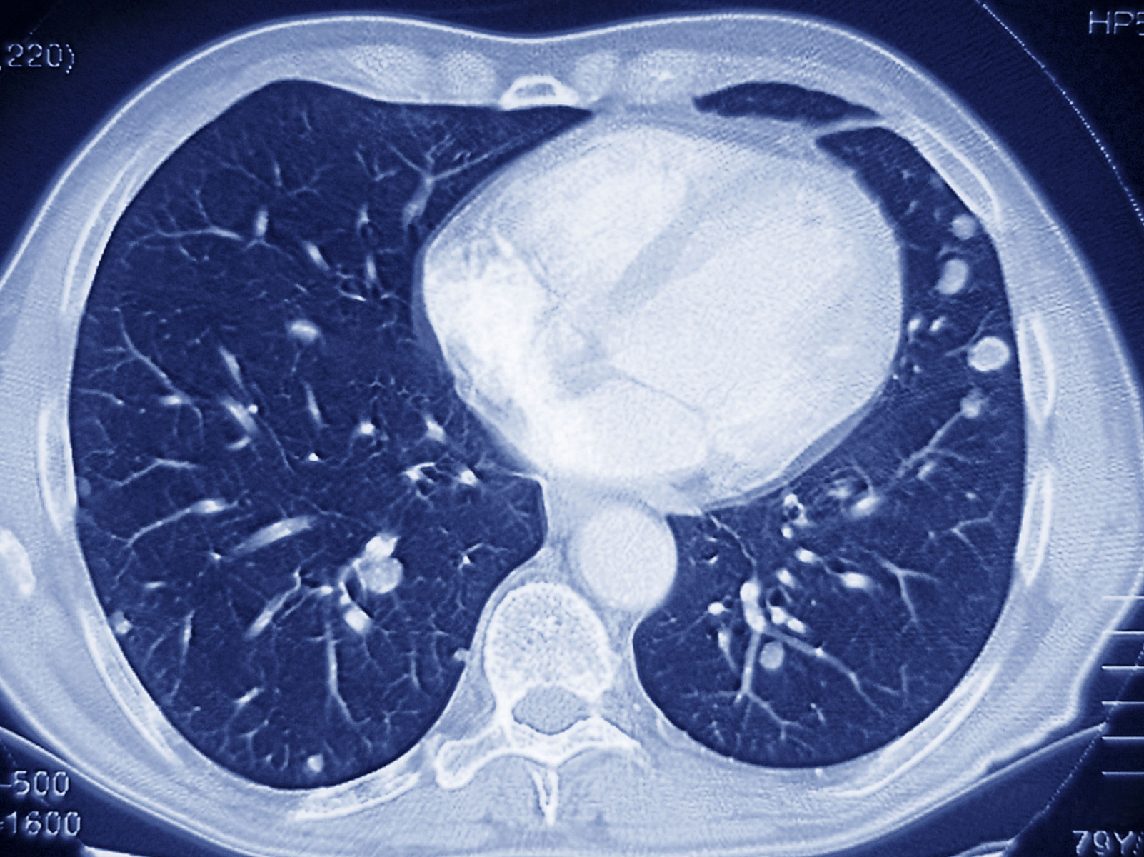 medicare-poised-to-cover-ct-scans-to-screen-for-lung-cancer-shots