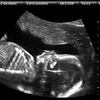 Ultrasound is often used for prenatal screening. It's just one of several prenatal screenings available to pregnant women.