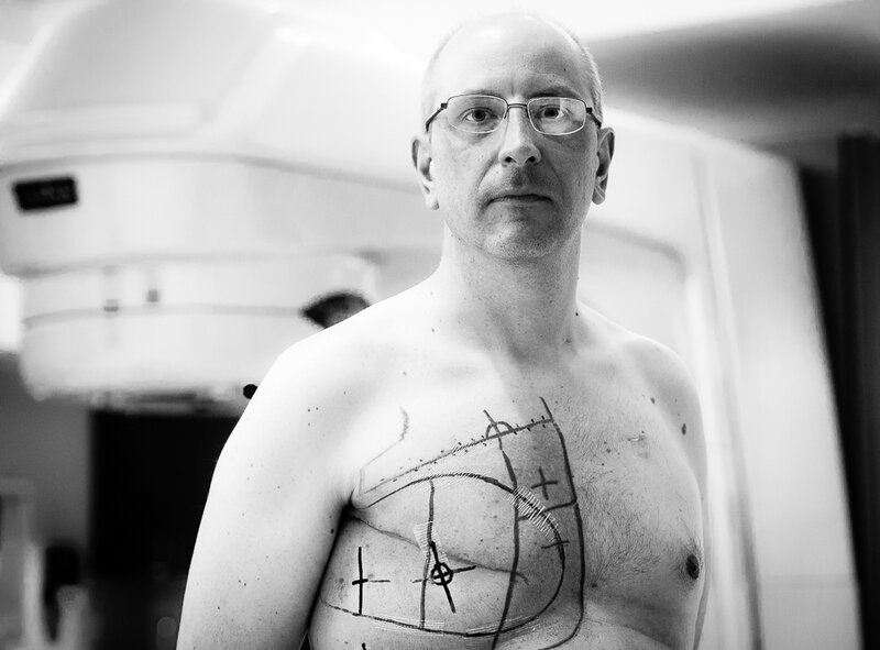 The markings on Oliver Bogler's chest are used to guide radiation therapy. (Courtesy of David Jay Photography)