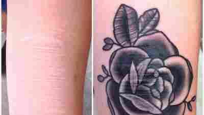 Maddie Keating shows her arm before and after her tattoo by Brian Finn which covered her scars.