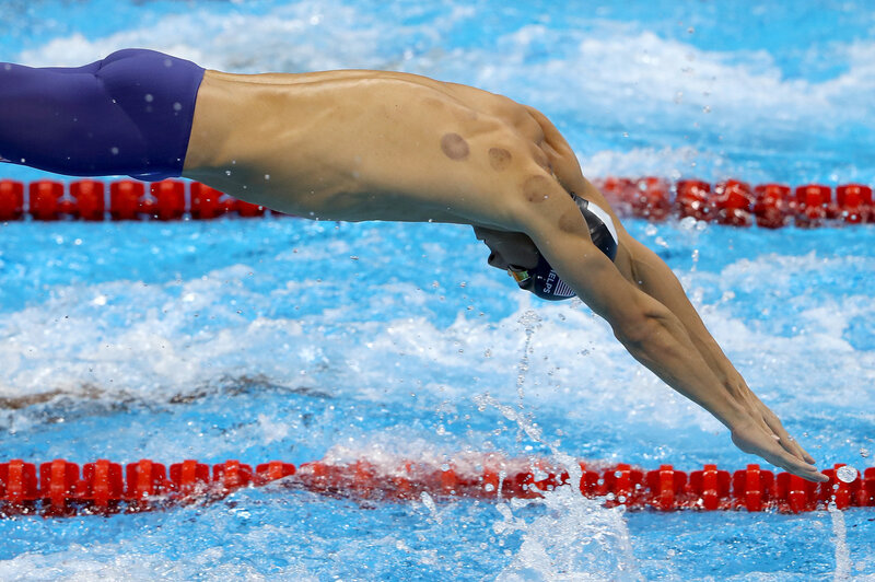 Michael Phelps shows signs of cupping on his way to another gold medal in Rio de Janeiro. Michael Phelps shows signs of cupping on his way to another gold medal in Rio de Janeiro.