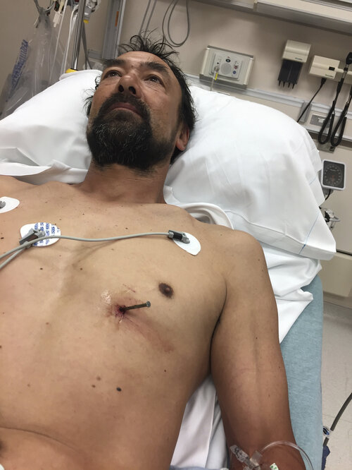 Doug Bergeson lies on a hospital bed at Aurora BayCare Medical Center in Green Bay, Wis., on June 25, before a doctor removed a nail from his heart. Bergeson had accidentally shot it into his heart earlier in the day while working on a new house in Peshtigo, Wis. He survived.
(Donna Bergeson/AP)