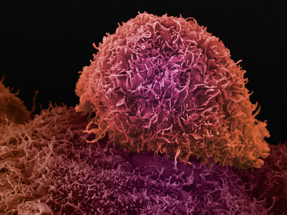 A microscope view of prostate cancer.