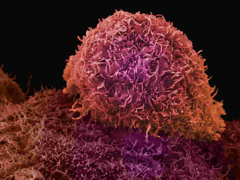 A microscope view of prostate cancer.