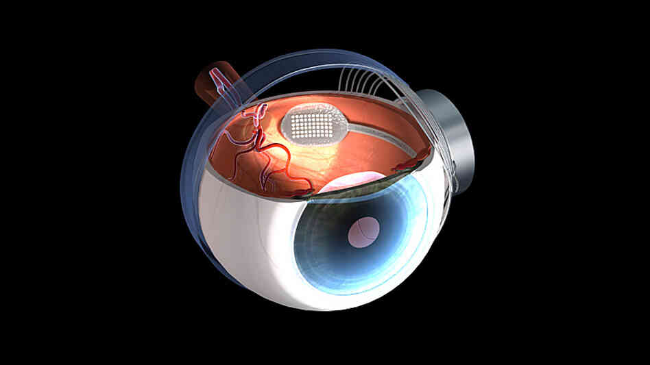 wide: A graphic shows a retinal prosthesis implanted in a human eye. wide: A graphic shows a retinal prosthesis implanted in a human eye.