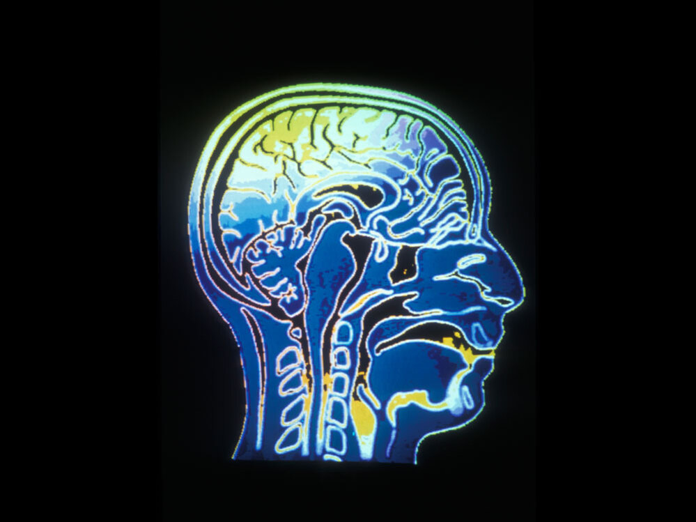 A CAT scan of a human head.