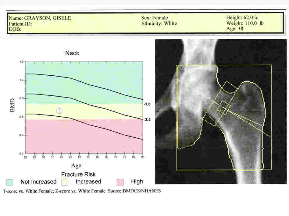 A sample bone scan report A sample bone scan report