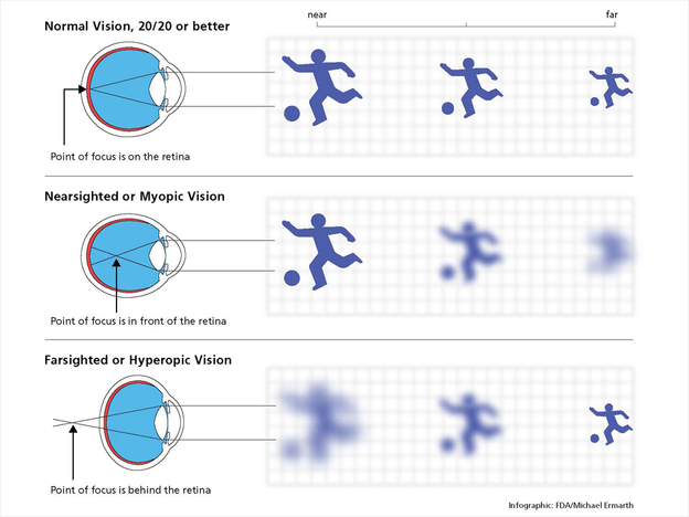 A look at nearsightedness and farsightedness.