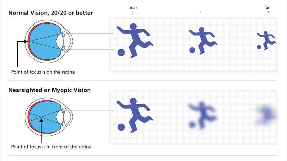Medical Detectives Focus On Myopia NPR