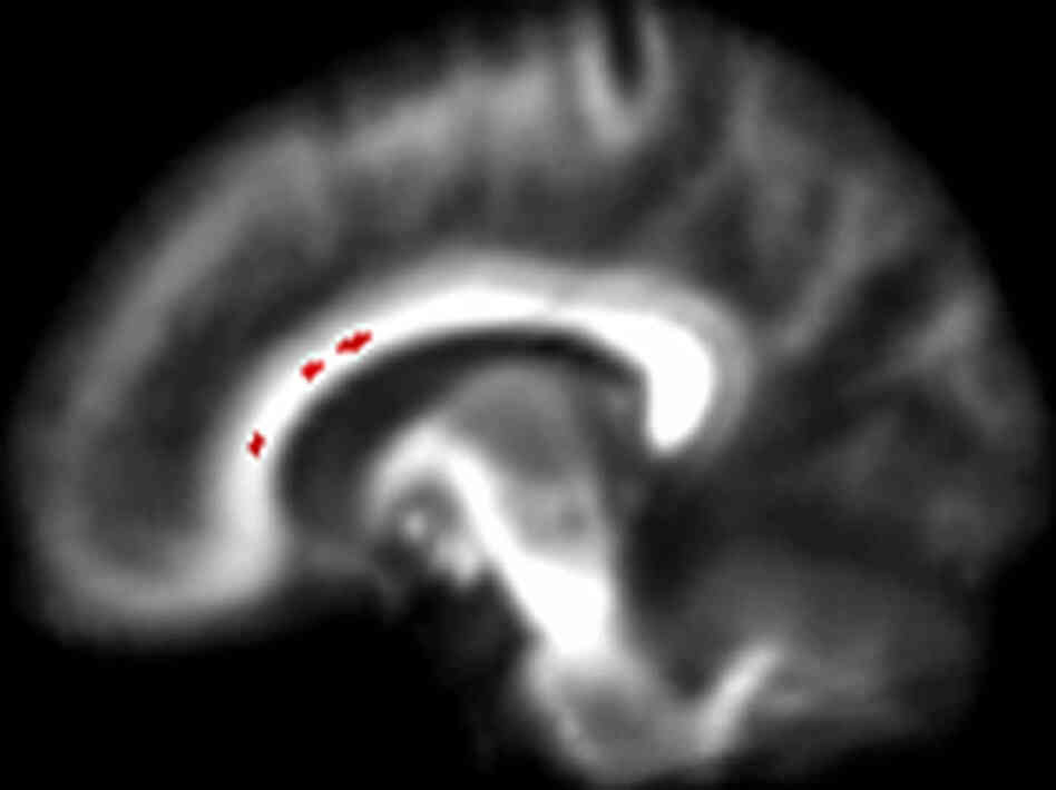 Damage to the brain of a teenage drinker, side view
