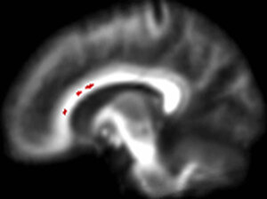 The red specks in this brain scan highlight where the integrity of the brain's white matter is significantly less in the teens who binge drink, compared to those who do not. [Souce: Susan Tapert/Tim McQueeny-UCSD/NPR