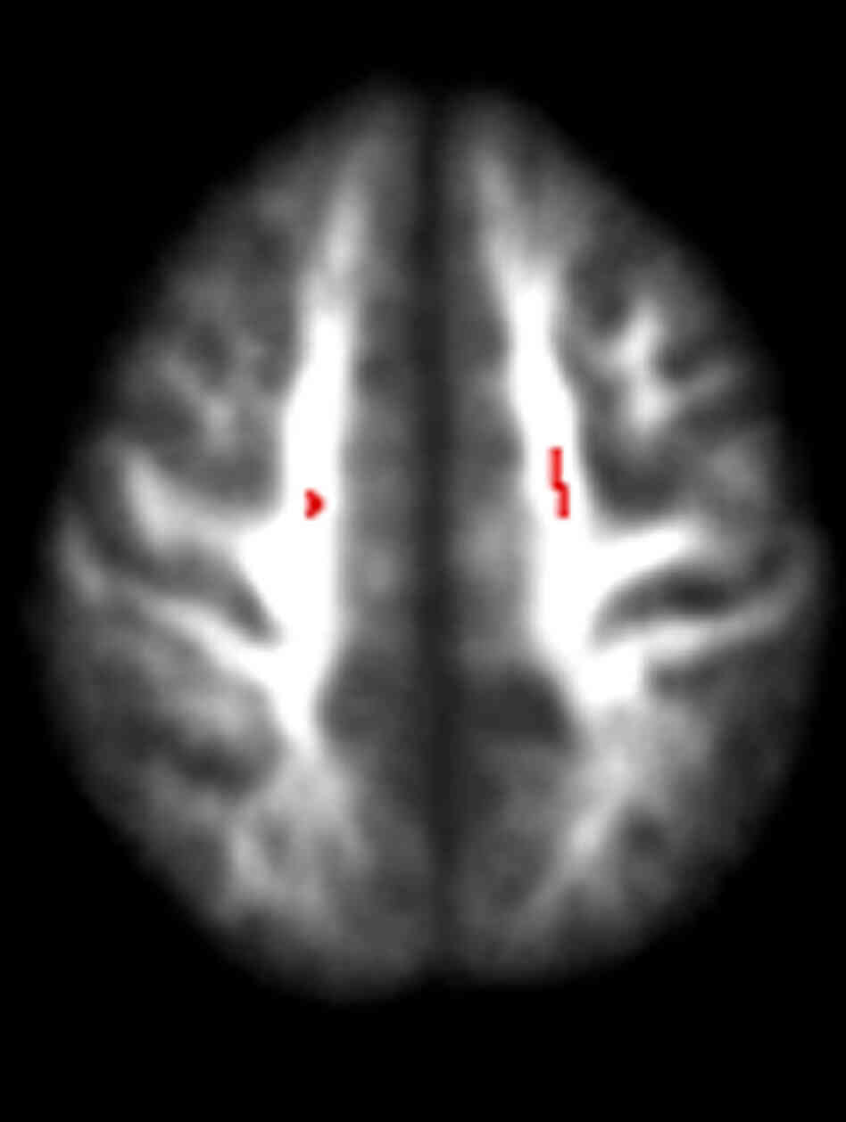 Damage to the brain of a teenage drinker, top view Damage to the brain of a teenage drinker, top view