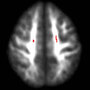 Damage to the brain of a teenage drinker, top view