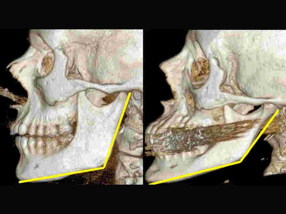 Jaw change in two skulls