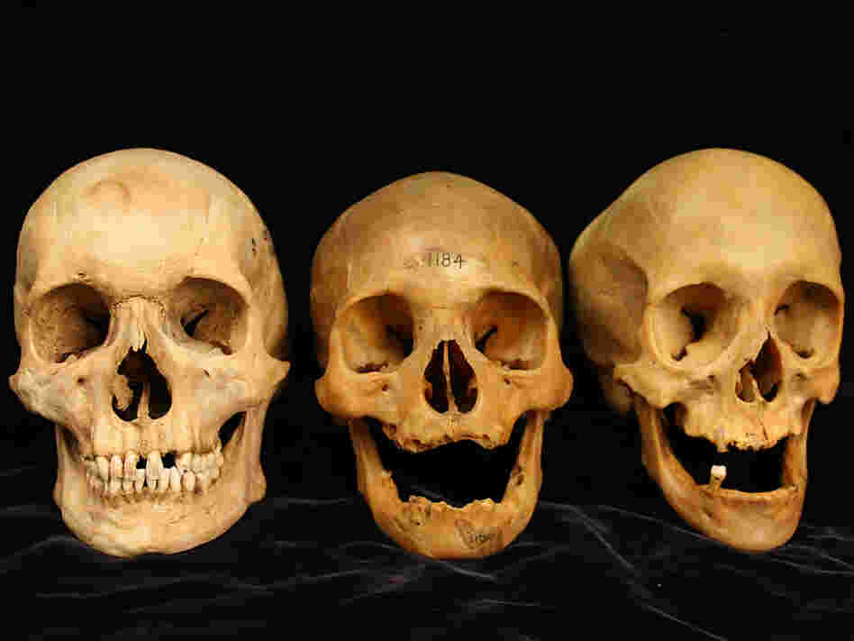 Three skulls showing a range of cheekbone deformation