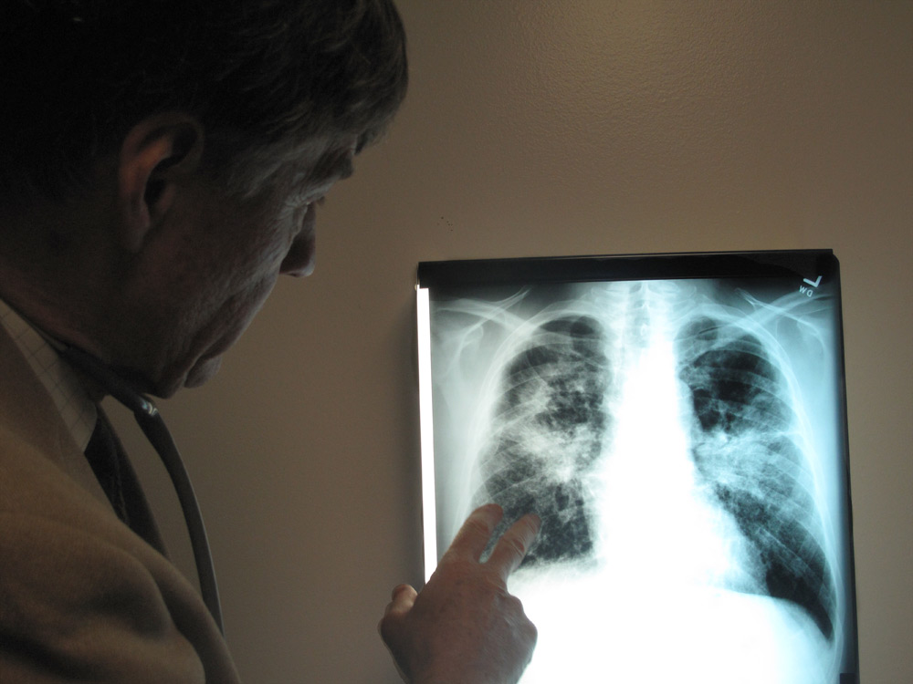 A doctor checks out a patient's lung scan that reveals coal dust in the lungs