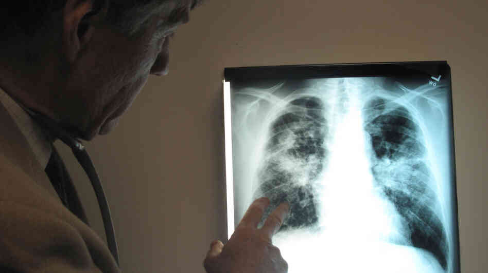 A doctor checks out a patient's lung scan that reveals coal dust in the lungs