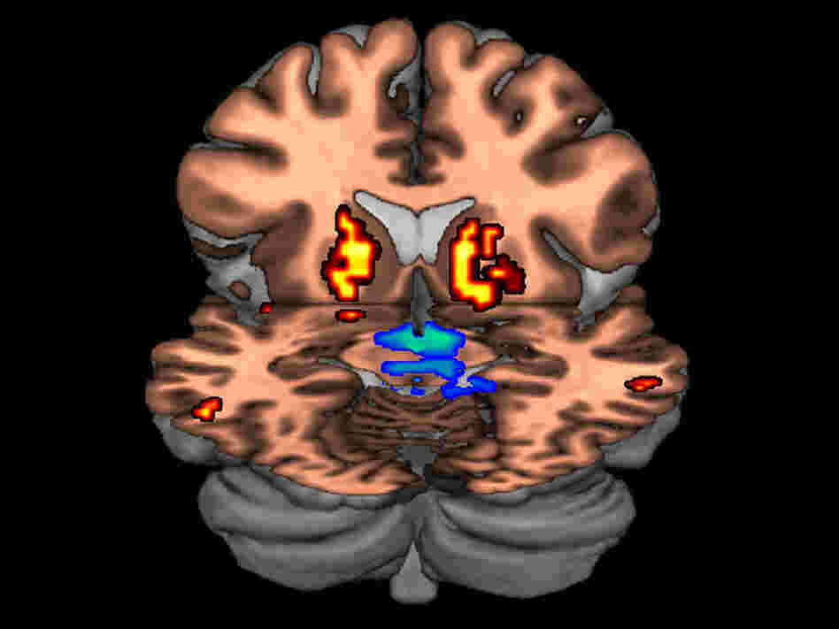 A composite PET brain scan showing low levels of dopamine receptors and high levels of dopamine.