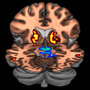 A composite PET brain scan showing low levels of dopamine receptors and high levels of dopamine.