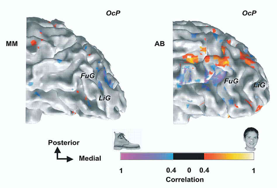The left picture is of Mike May's brain and on the right is the brain of a seeing person. The left picture is of Mike May's brain and on the right is the brain of a seeing person.