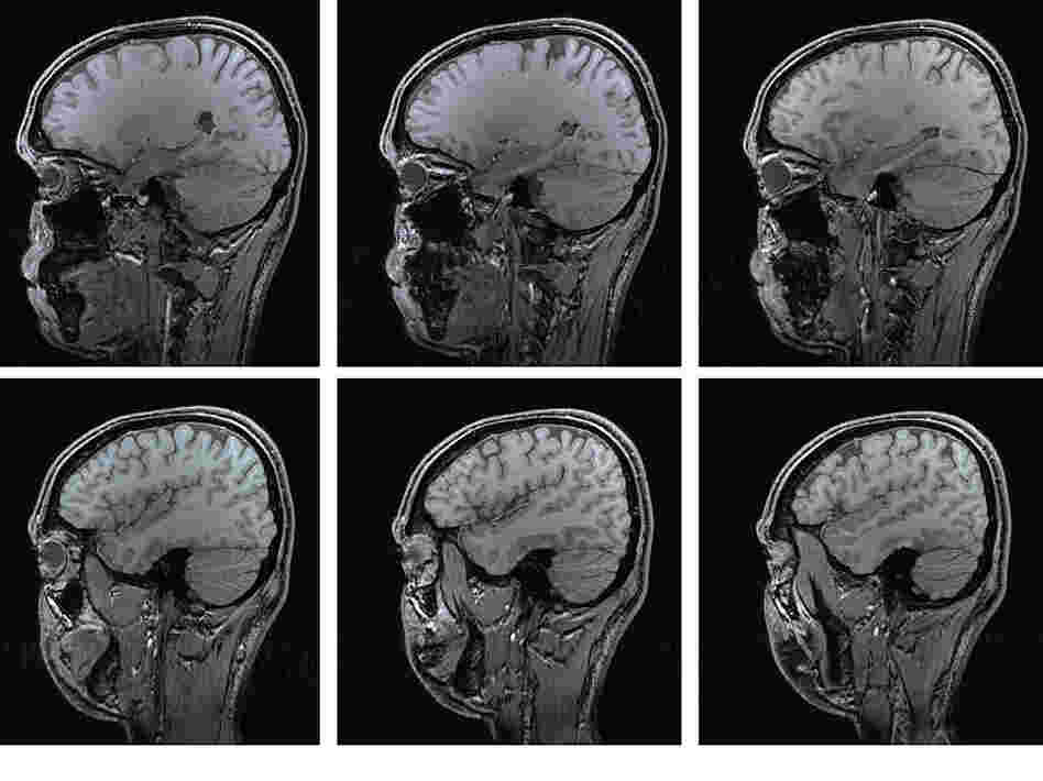 Stray abnormalities that show up in MRI scans usually don’t amount to much.