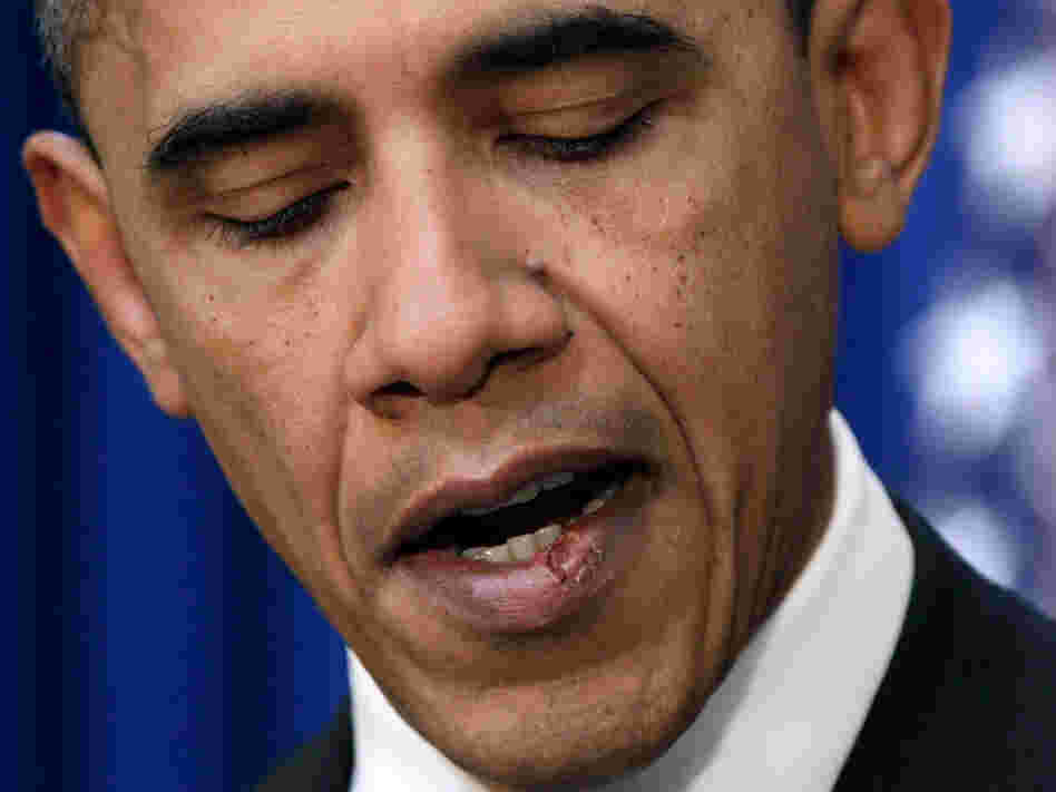 A close-up view of stitches in President Obama's lower lip, the result of an errant elbow to the mouth during a friendly basketball game in November.