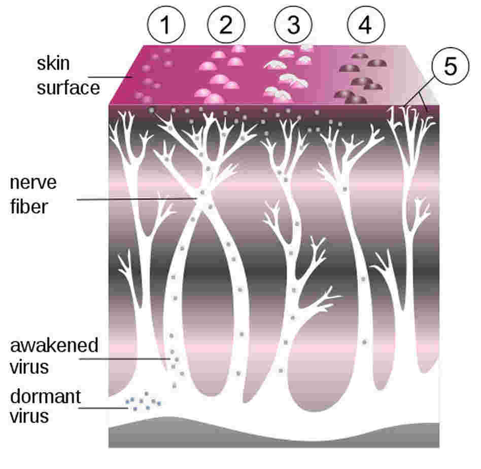 A diagram of the shingles virus. A diagram of the shingles virus.