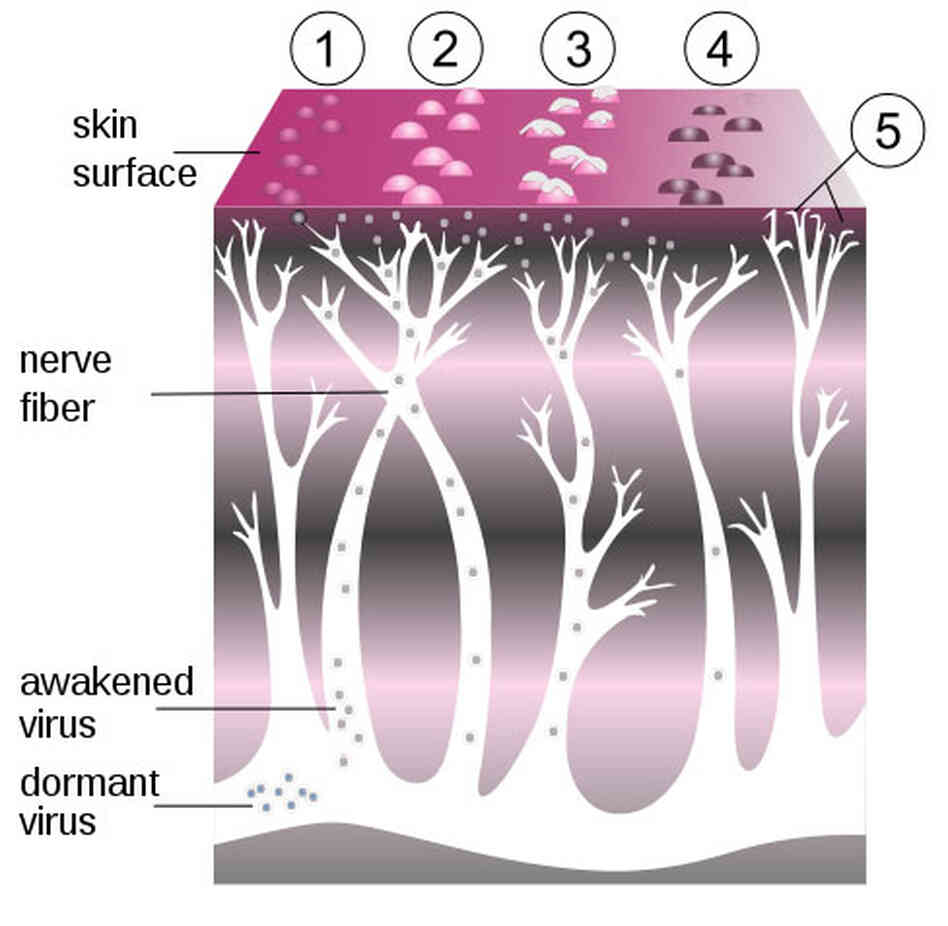 A diagram of the shingles virus. A diagram of the shingles virus.
