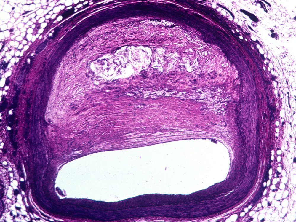 Light micrograph of atherosclerosis, the buildup of plaque on arterial walls