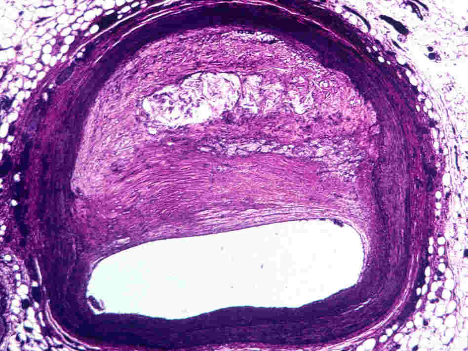 Light micrograph of atherosclerosis, the buildup of plaque on arterial walls