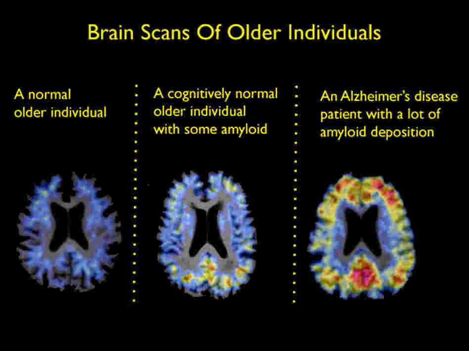 Brain scans of healthy older brains and those with plaques