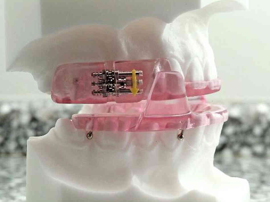 Oral appliances can help many sleep apnea patients maintain regular breathing.